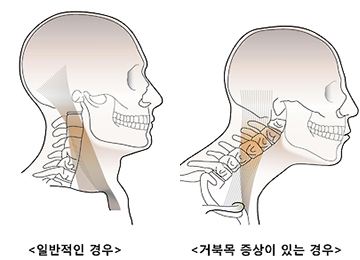 智能手机时代“乌龟脖综合征”患者4年间翻一番。 - 中韩人力网 